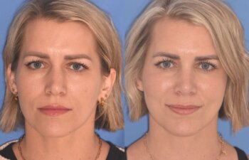 35 YR - 5 Weeks Postop: Rhinoplasty