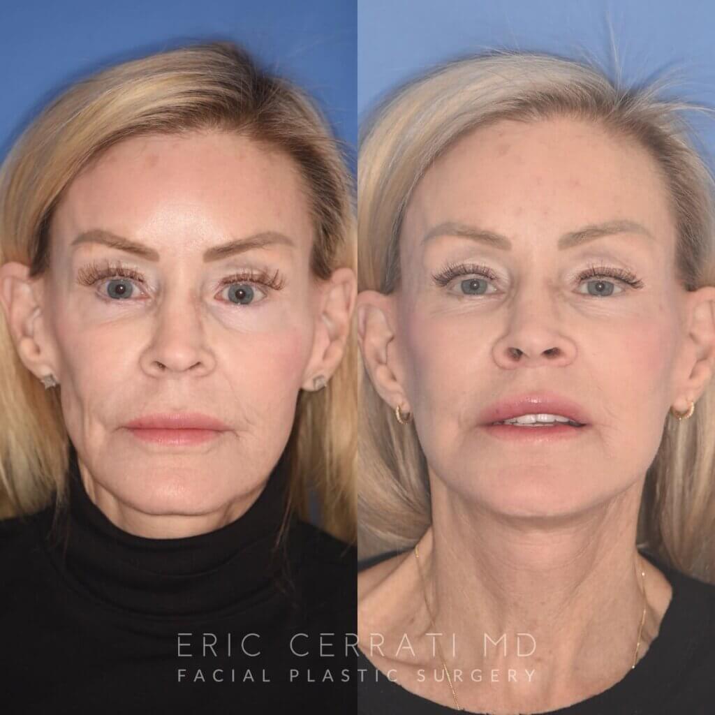 3 YR - 4 Months Postop: Revision Facelift + Fat Grafting + Liplift + Laser