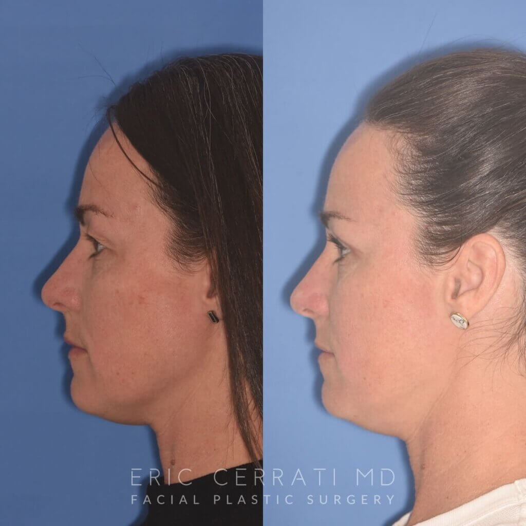 40 YR - 5 Weeks Postop: Upper Blepharoplasty