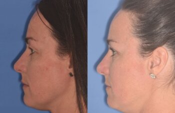 40 YR - 5 Weeks Postop: Upper Blepharoplasty