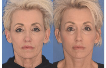 64 YR - 1 Month Postop: Endoscopic Browlift + Upper Eyelid Ptosis Repair + Facelift + Laser