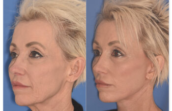 64 YR - 1 Month Postop: Endoscopic Browlift + Upper Eyelid Ptosis Repair + Facelift + Laser