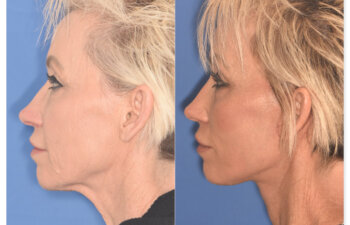 64 YR - 1 Month Postop: Endoscopic Browlift + Upper Eyelid Ptosis Repair + Facelift + Laser