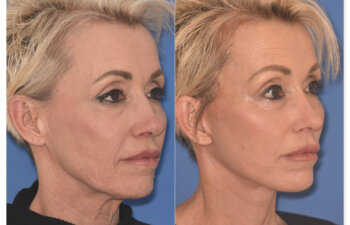 64 YR - 1 Month Postop: Endoscopic Browlift + Upper Eyelid Ptosis Repair + Facelift + Laser