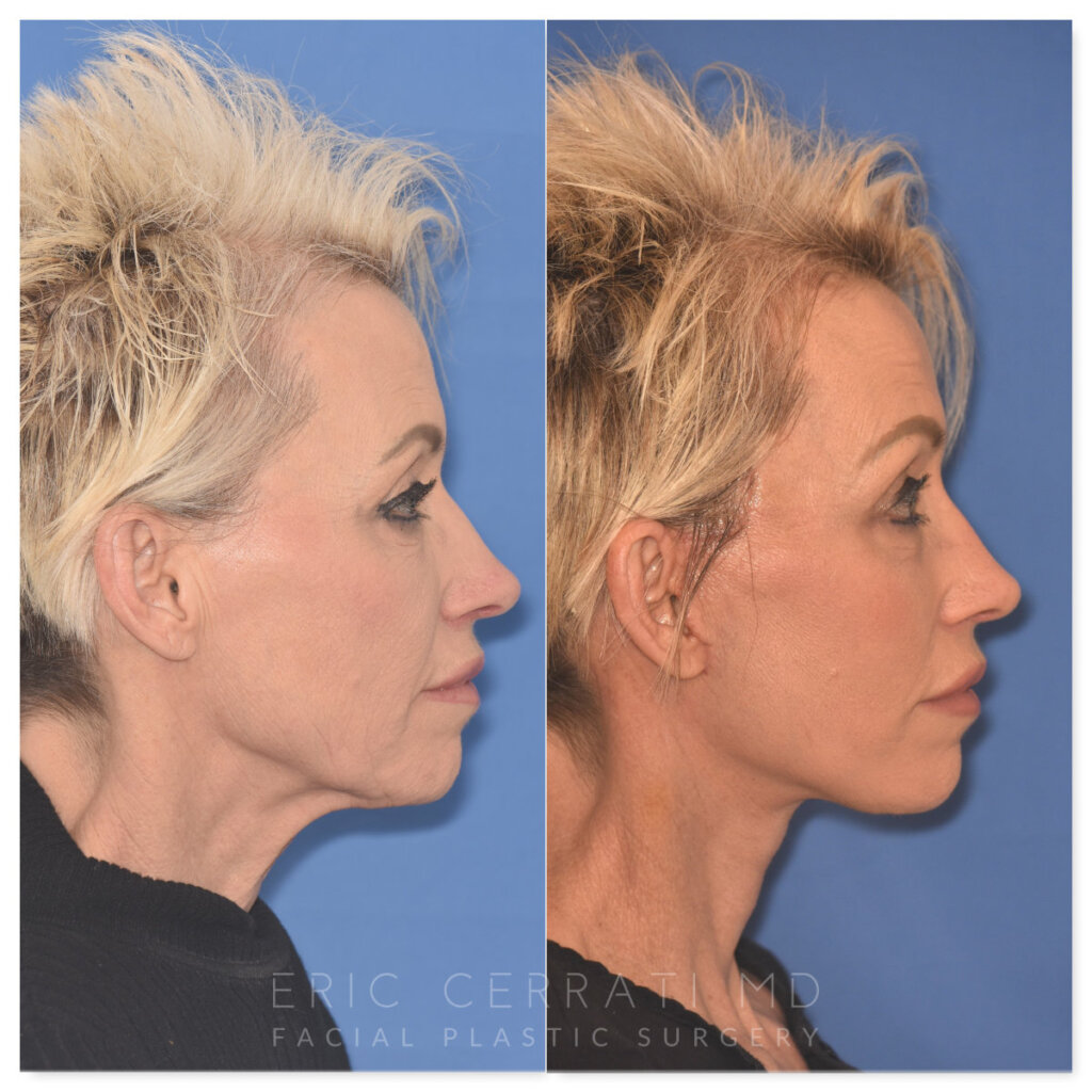 64 YR - 1 Month Postop: Endoscopic Browlift + Upper Eyelid Ptosis Repair + Facelift + Laser