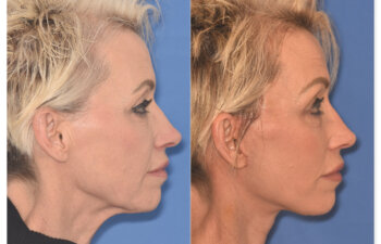 64 YR - 1 Month Postop: Endoscopic Browlift + Upper Eyelid Ptosis Repair + Facelift + Laser