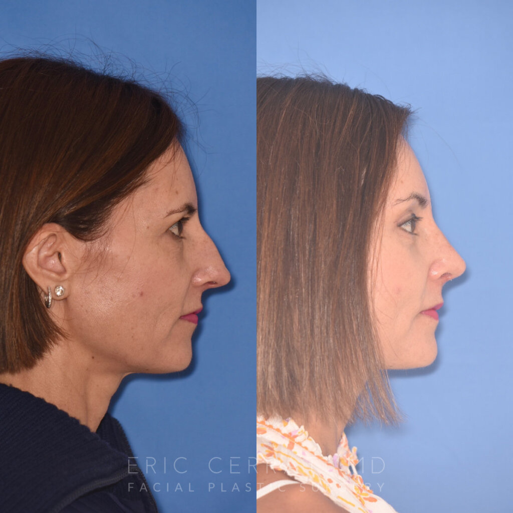 50 YR - 5 Weeks Postop: Endoscopic Browlift + Upper Blepharoplasty + Lower Blepharoplasty + Rhinoplasty