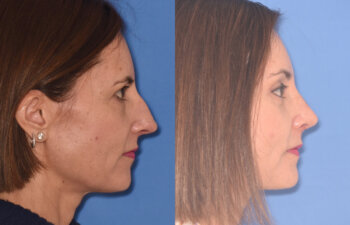 50 YR - 5 Weeks Postop: Endoscopic Browlift + Upper Blepharoplasty + Lower Blepharoplasty + Rhinoplasty