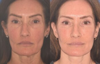 55 YR - 4 Months Postop: Facelift + Revision Upper Blepharoplasty +Lower Blepharoplasty + Laser
