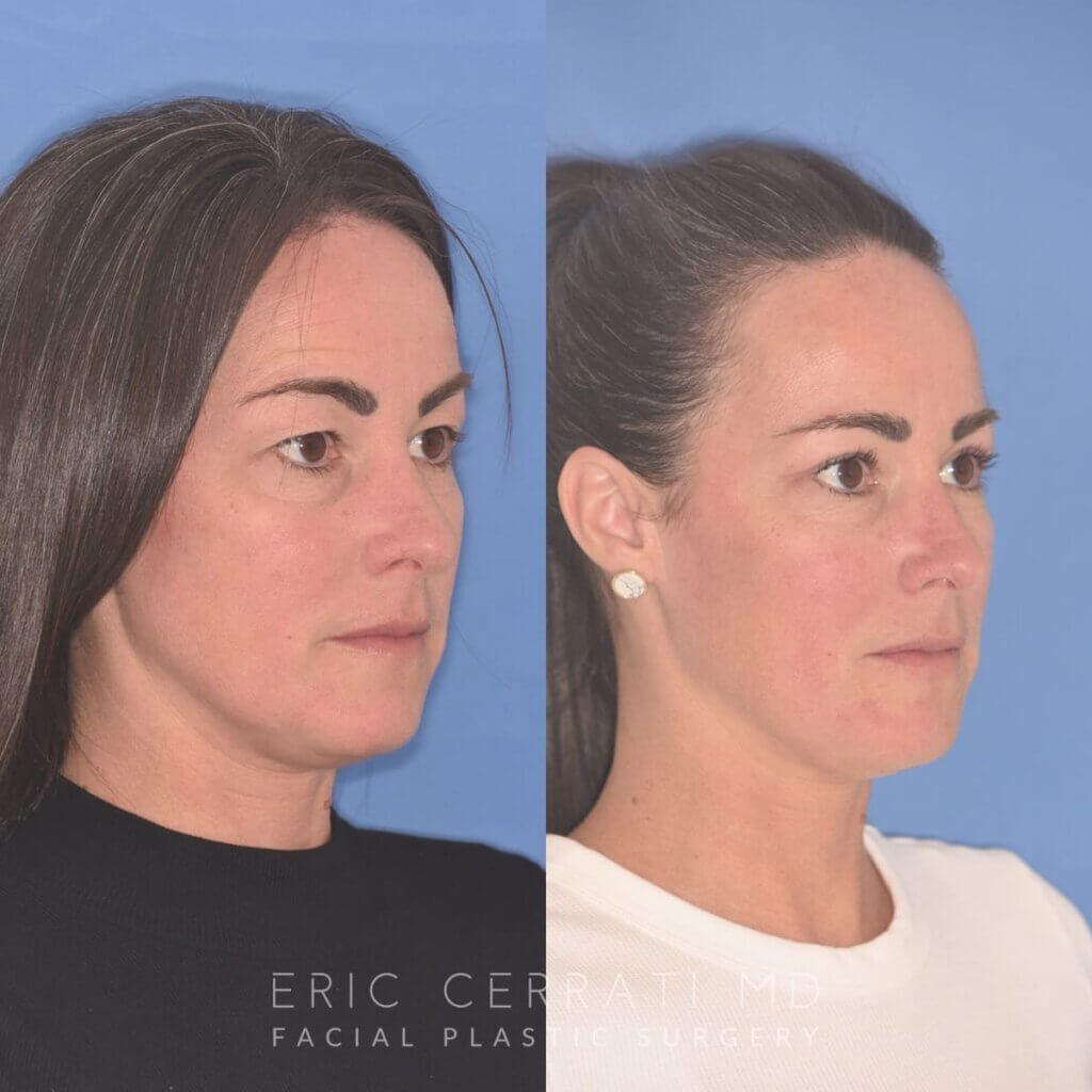 40 YR - 5 Weeks Postop: Upper Blepharoplasty