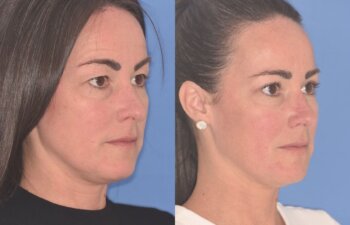 40 YR - 5 Weeks Postop: Upper Blepharoplasty