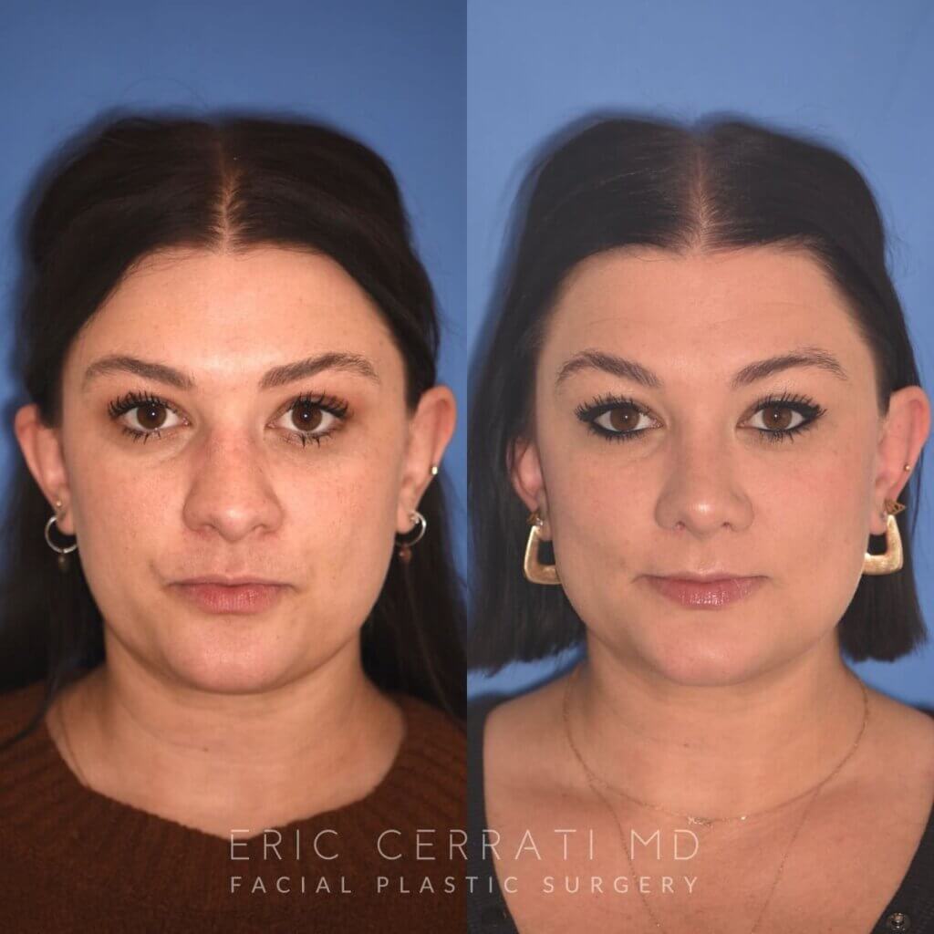 31 YR - 4 Months Postop: Rhinoplasty