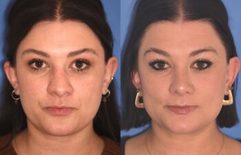31 YR - 4 Months Postop: Rhinoplasty