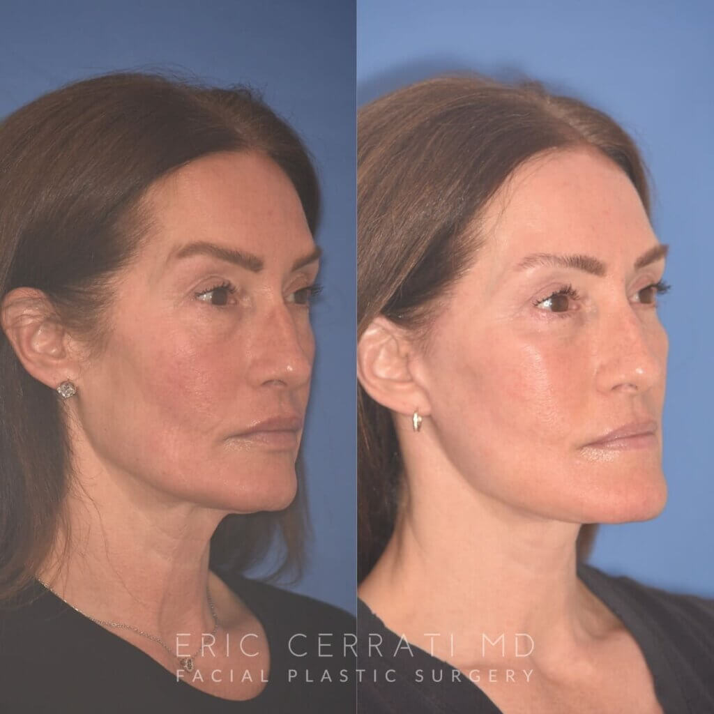 55 YR - 4 Months Postop: Facelift + Revision Upper Blepharoplasty +Lower Blepharoplasty + Laser