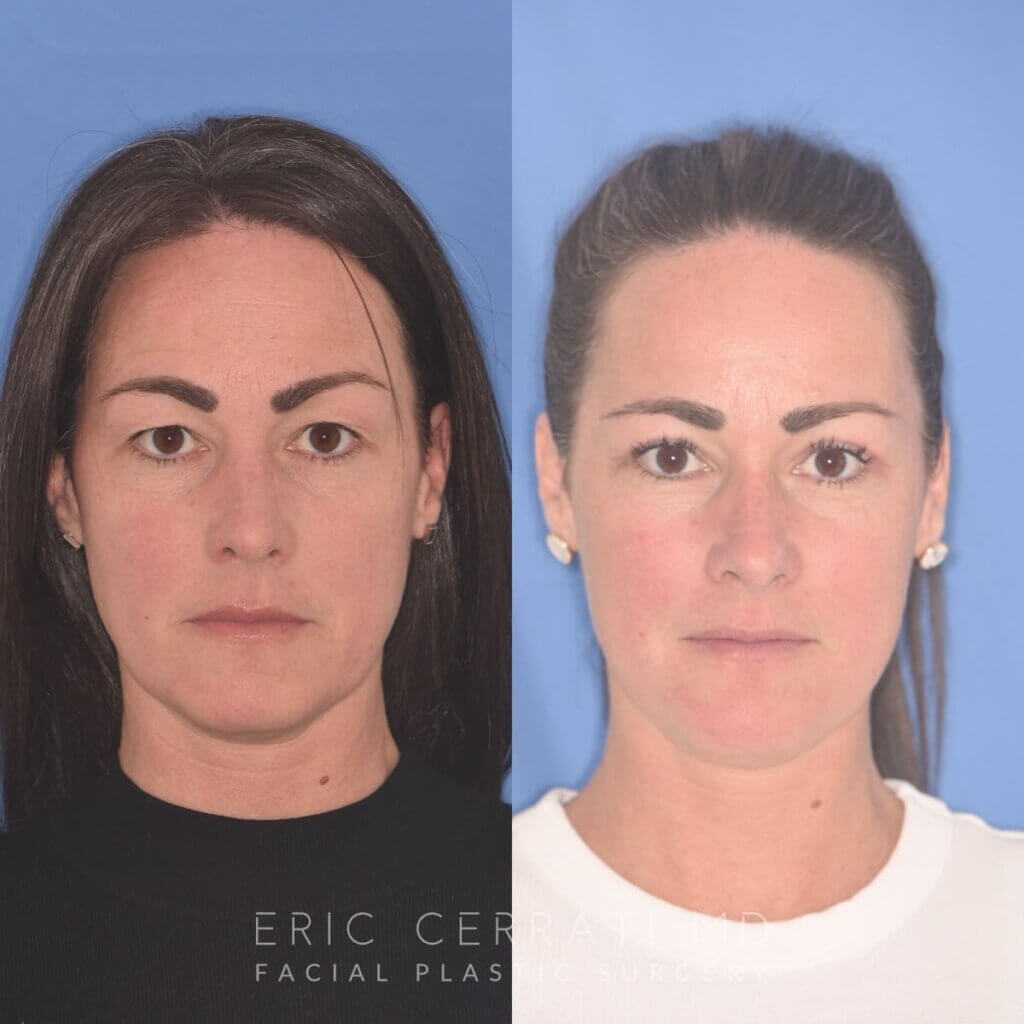40 YR - 5 Weeks Postop: Upper Blepharoplasty