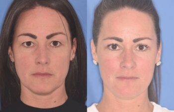 40 YR - 5 Weeks Postop: Upper Blepharoplasty
