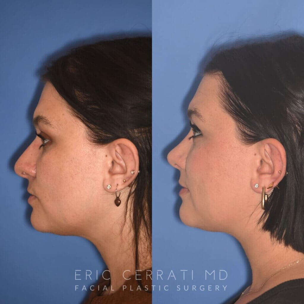 31 YR - 4 Months Postop: Rhinoplasty