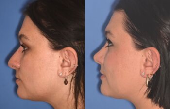 31 YR - 4 Months Postop: Rhinoplasty