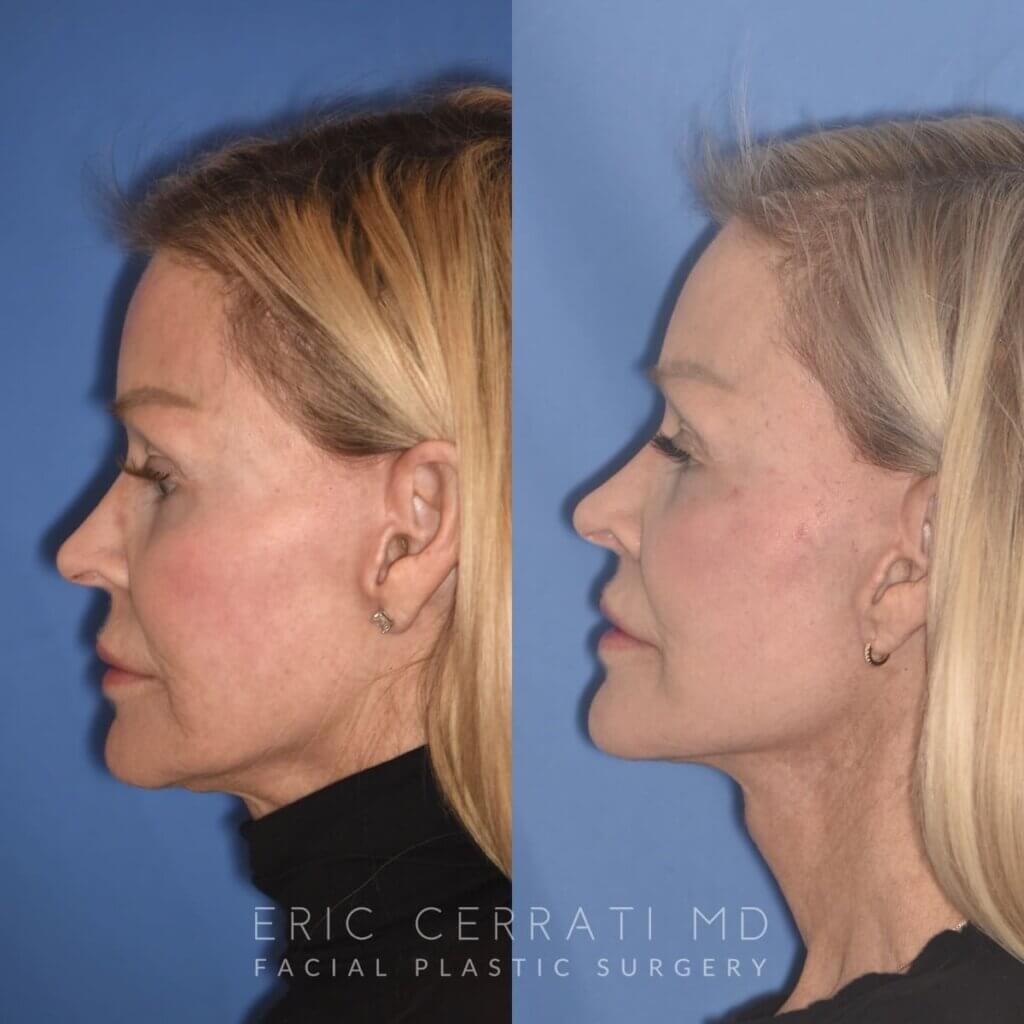 3 YR - 4 Months Postop: Revision Facelift + Fat Grafting + Liplift + Laser