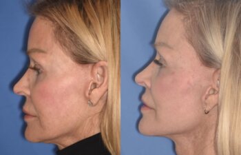 3 YR - 4 Months Postop: Revision Facelift + Fat Grafting + Liplift + Laser