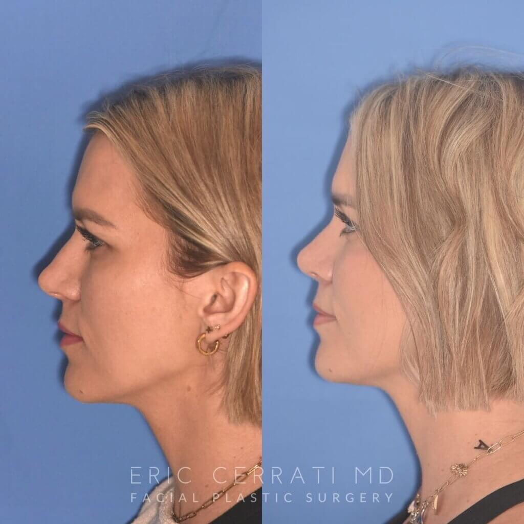 35 YR - 5 Weeks Postop: Rhinoplasty