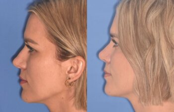 35 YR - 5 Weeks Postop: Rhinoplasty