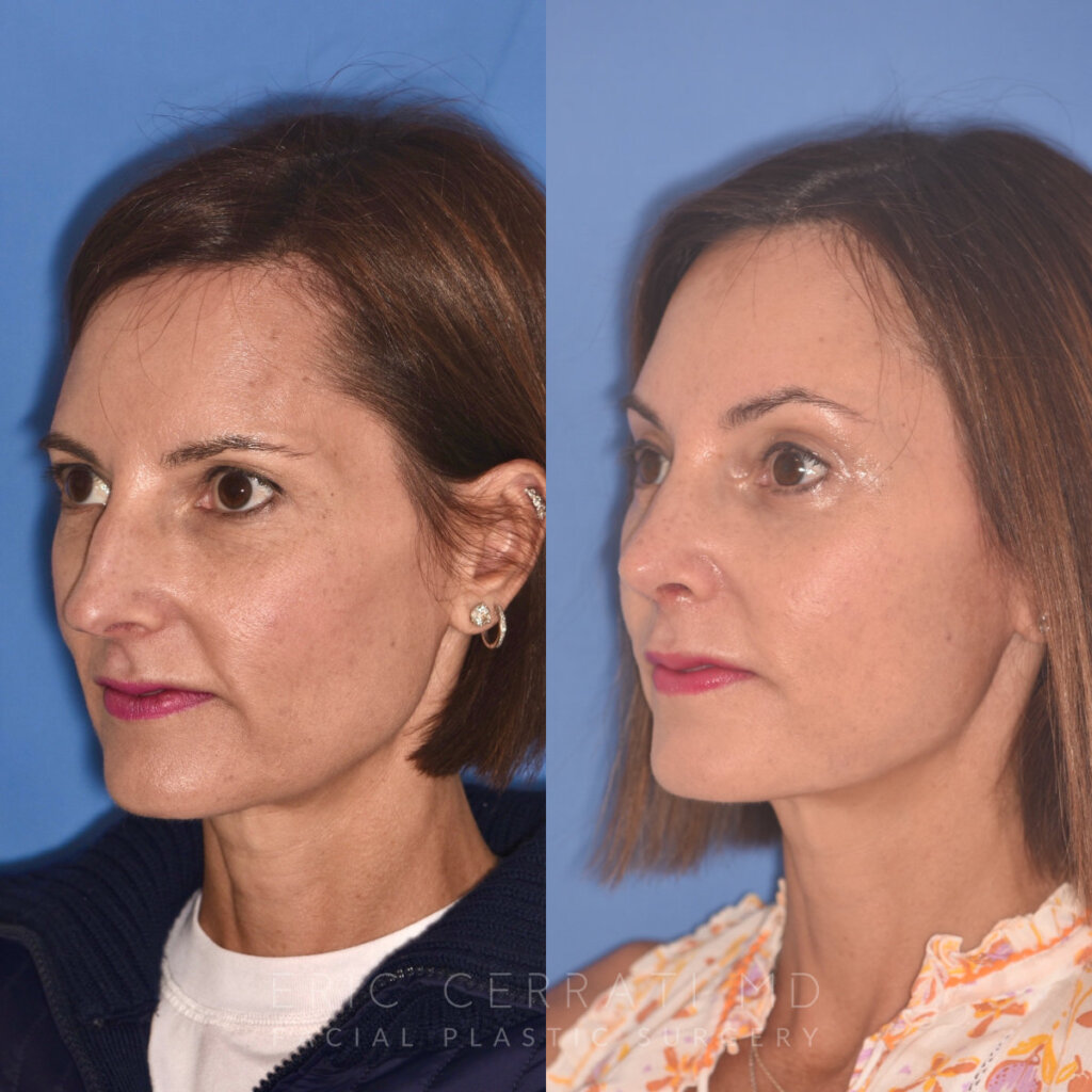 50 YR - 5 Weeks Postop: Endoscopic Browlift + Upper Blepharoplasty + Lower Blepharoplasty + Rhinoplasty