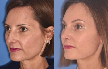 50 YR - 5 Weeks Postop: Endoscopic Browlift + Upper Blepharoplasty + Lower Blepharoplasty + Rhinoplasty