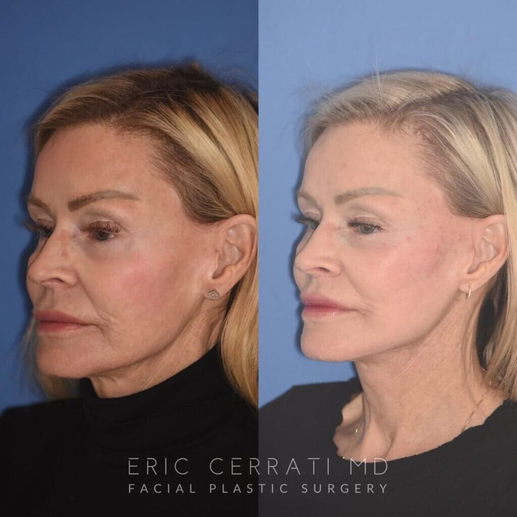 3 YR - 4 Months Postop: Revision Facelift + Fat Grafting + Liplift + Laser