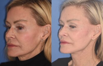3 YR - 4 Months Postop: Revision Facelift + Fat Grafting + Liplift + Laser