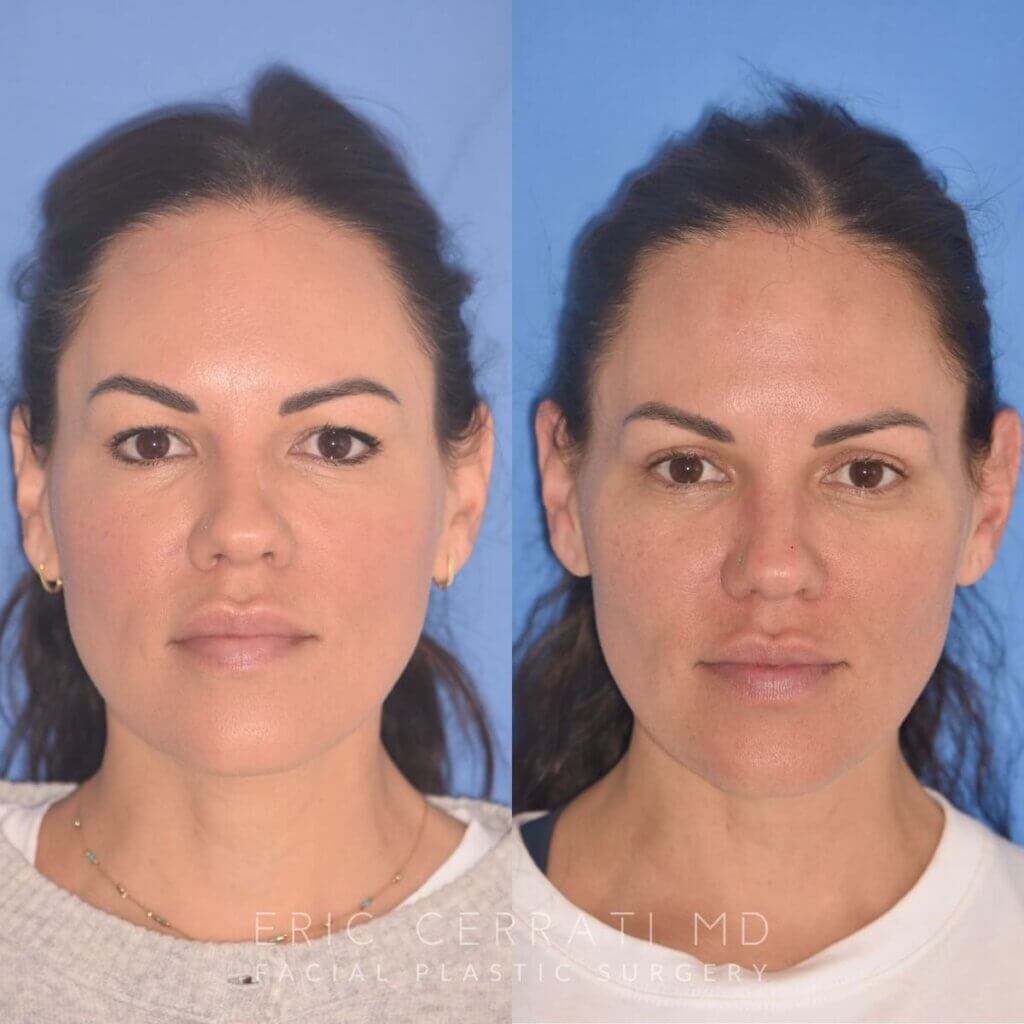 42 YR - 5 Weeks Postop: Upper Blepharoplasty