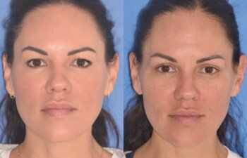 42 YR - 5 Weeks Postop: Upper Blepharoplasty