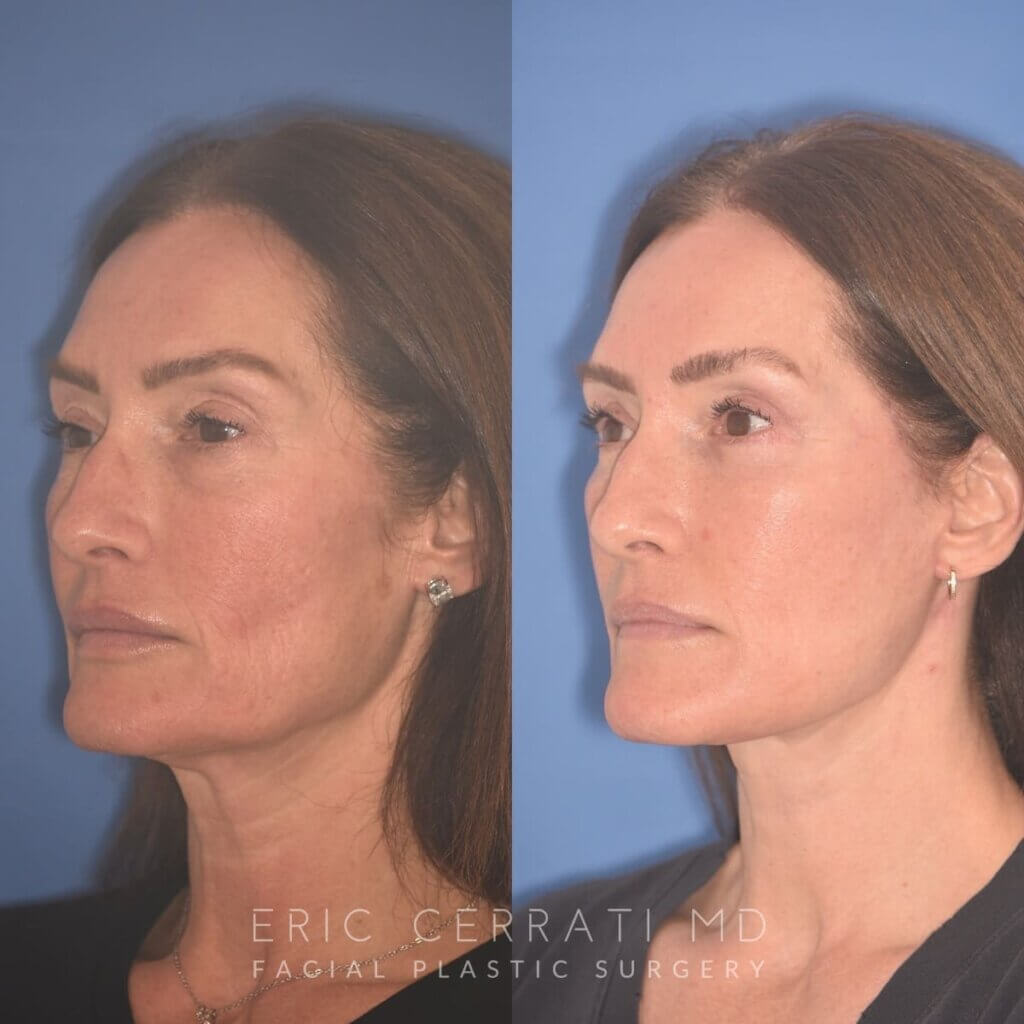 55 YR - 4 Months Postop: Facelift + Revision Upper Blepharoplasty +Lower Blepharoplasty + Laser