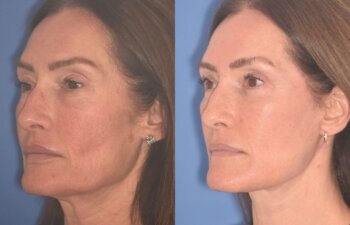 55 YR - 4 Months Postop: Facelift + Revision Upper Blepharoplasty +Lower Blepharoplasty + Laser