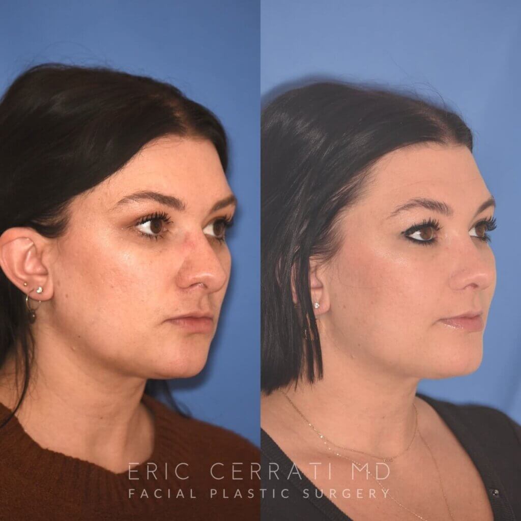 31 YR - 4 Months Postop: Rhinoplasty