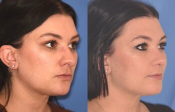 31 YR - 4 Months Postop: Rhinoplasty