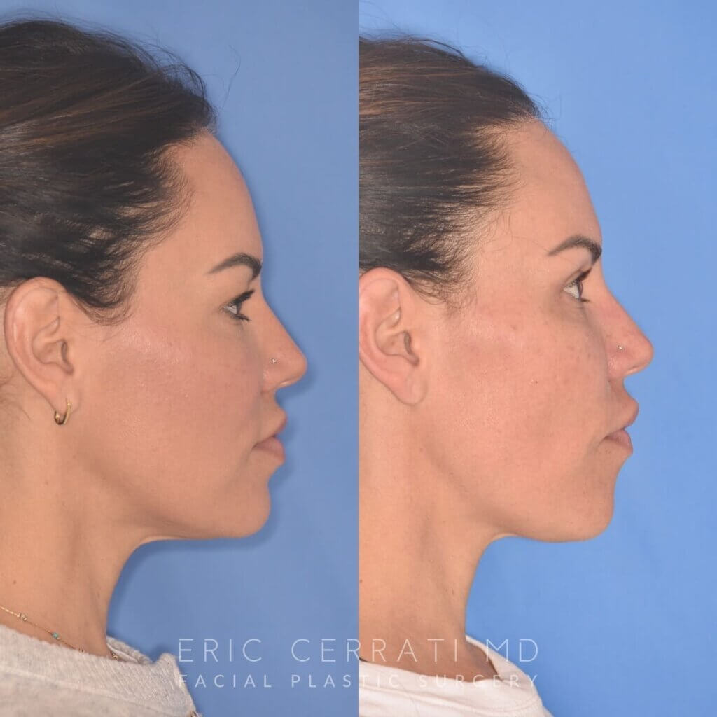 42 YR - 5 Weeks Postop: Upper Blepharoplasty