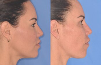 42 YR - 5 Weeks Postop: Upper Blepharoplasty