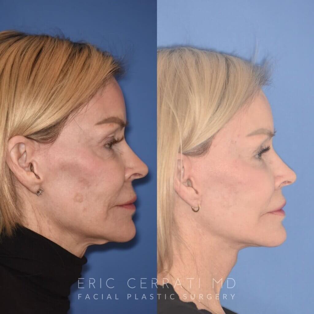 3 YR - 4 Months Postop: Revision Facelift + Fat Grafting + Liplift + Laser