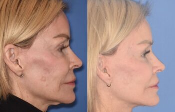 3 YR - 4 Months Postop: Revision Facelift + Fat Grafting + Liplift + Laser