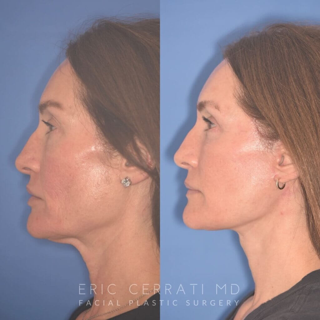 55 YR - 4 Months Postop: Facelift + Revision Upper Blepharoplasty +Lower Blepharoplasty + Laser