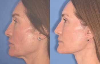55 YR - 4 Months Postop: Facelift + Revision Upper Blepharoplasty +Lower Blepharoplasty + Laser