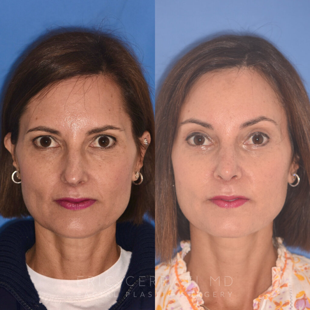 50 YR - 5 Weeks Postop: Endoscopic Browlift + Upper Blepharoplasty + Lower Blepharoplasty + Rhinoplasty