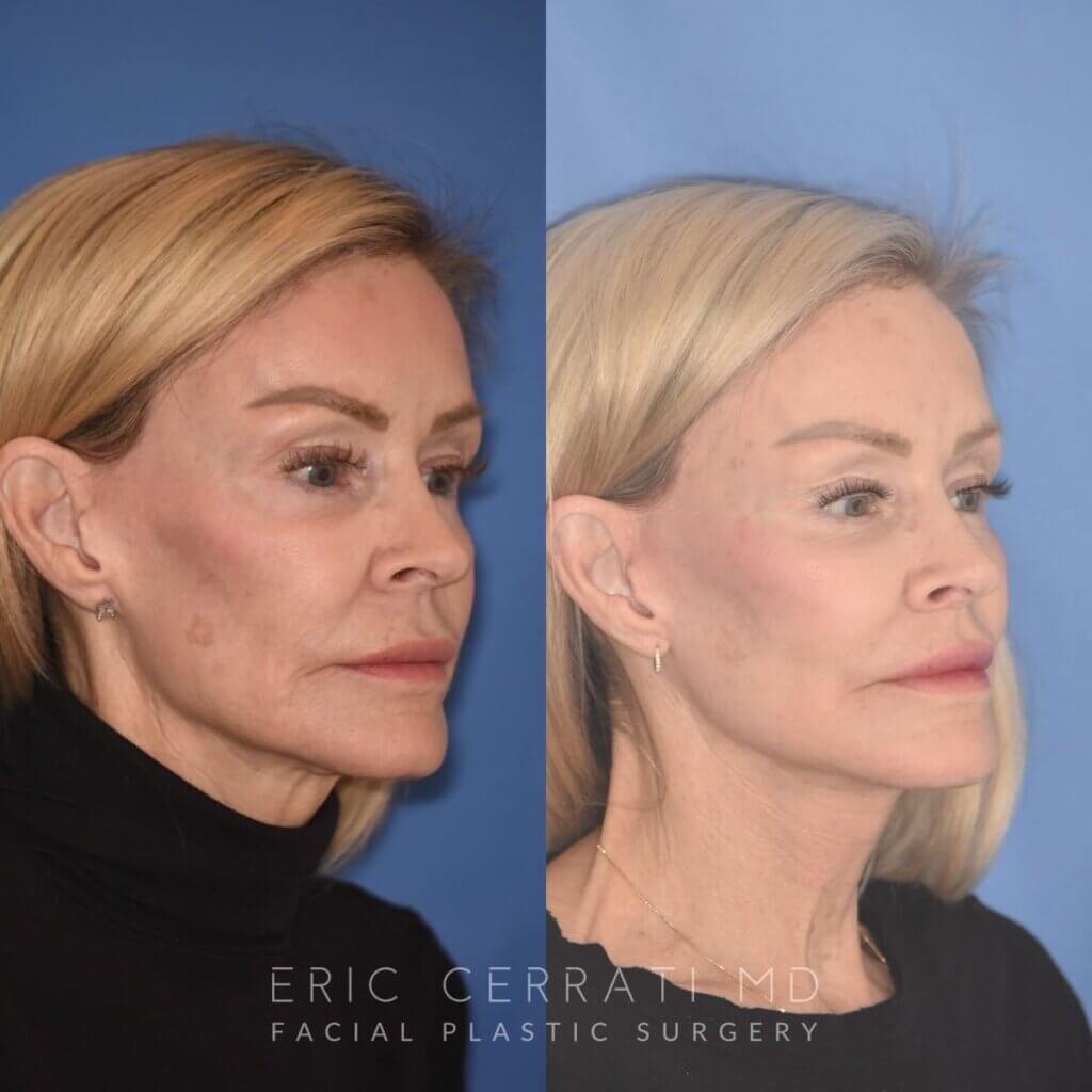 3 YR - 4 Months Postop: Revision Facelift + Fat Grafting + Liplift + Laser