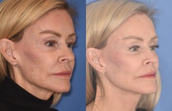 3 YR - 4 Months Postop: Revision Facelift + Fat Grafting + Liplift + Laser