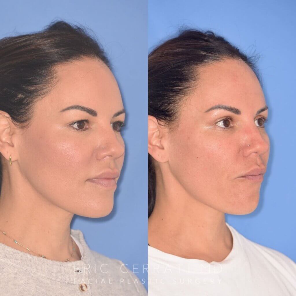 42 YR - 5 Weeks Postop: Upper Blepharoplasty