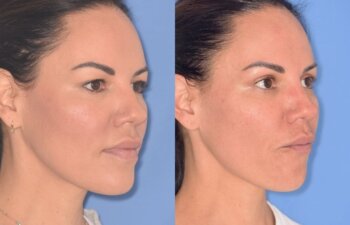 42 YR - 5 Weeks Postop: Upper Blepharoplasty