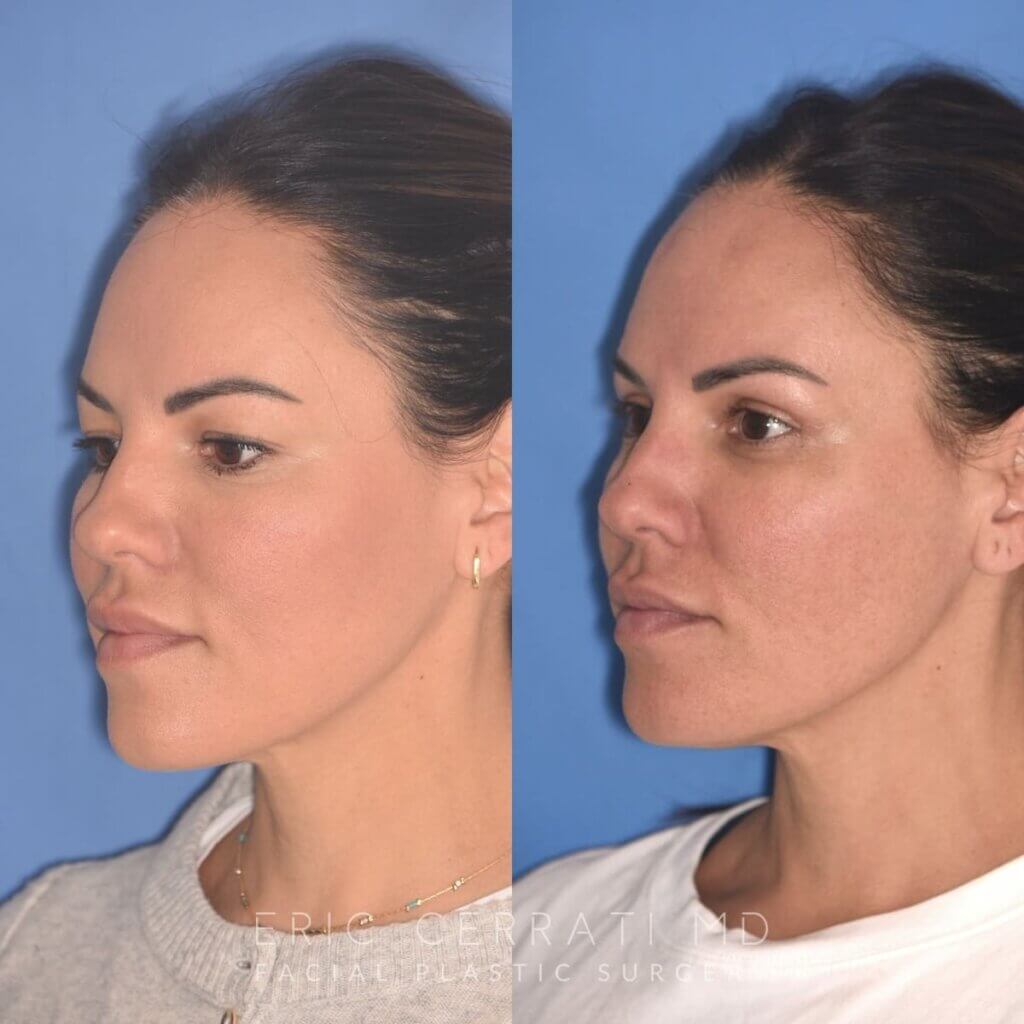 42 YR - 5 Weeks Postop: Upper Blepharoplasty