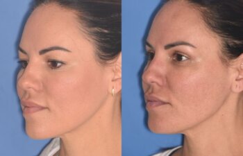 42 YR - 5 Weeks Postop: Upper Blepharoplasty