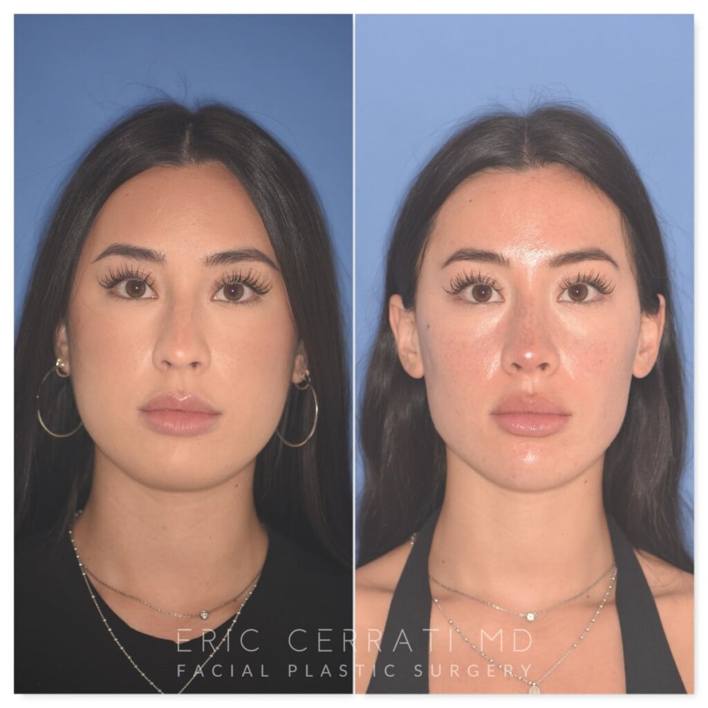 Before and after rhinoplasty, 25-year-old patient, front view, 9 months post-op by Dr. Cerrati